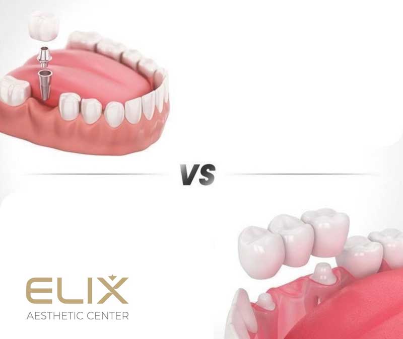 Имплантат или коронка: что выбрать?